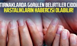 Tırnaklarda görülen bu belirtiler ciddi hastalıkların habercisi olabilir!